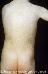 Ichthyosis vulgaris